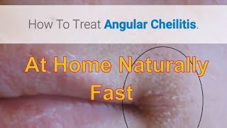 How To Treat Angular Cheilitis Naturally At Home Remedy That Works [upl. by Zantos]