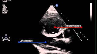 3B Parasternal long axis view of the left ventricle pulmonary hypertension [upl. by Franciscka]