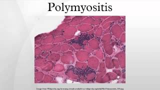 Polymyositis [upl. by Aryn]