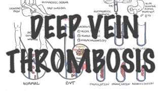 Deep Vein Thrombosis  Overview pathophysiology treatment complications [upl. by Venus]