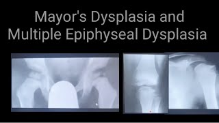 Mayors Dysplasia and Multiple Epiphyseal Dysplasia Radiology anx Xrays findings [upl. by Kreiker]