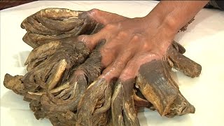 Bangladeshi man with treelike growth on hands undergoes first corrective surgery [upl. by Cod]