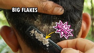 Dry Flaky Scalp Removal Dandruff Scratching Satisfying 277 [upl. by Lovash]