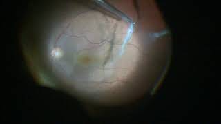 Macular Hole Vitrectomy Surgery [upl. by Nallaf]