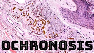 Ochronosis dark skin pigmentation caused by hydroquinone skin lightening cream or alkaptonuria [upl. by Ydnem]