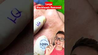 CRAZY BLACKHEAD REMOVAL  Huge Blackheads On Nose shorts [upl. by Bound888]