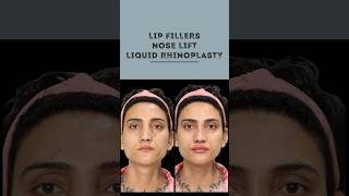 Transform Your Look Nose Lift amp Lip Fillers  Sarayu Clinics beauty [upl. by Mrots]