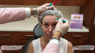 Full Face Botox Consultation and Injection by Dr Valaie MD [upl. by Leatri]