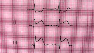 infarctus aigu et inferieur du myocarde [upl. by Slayton]