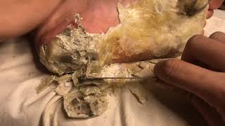 How to removal skin  callus removal skin flakes 53 [upl. by Narbig713]