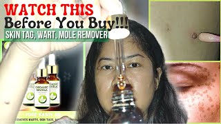 Removal Of Warts Moles Etc  Effective Skin Tag Remover  Organic Manila Pure Kasoy Oil [upl. by Ahtnamys]