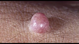 Melanocytic Nevi Moles Week 10 Winter 2020 Dermatology [upl. by Ellingston]