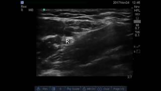 USG SCREENING OF AXILLARY BRACHEAL PLEXUS BLOCK [upl. by Nairrad]