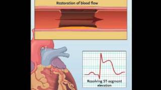 NEJM Procedure Primary PCI for Myocardial Infarction with STSegmented Elevation [upl. by Dranoel]