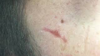 Acne scars subcision [upl. by Ynot]