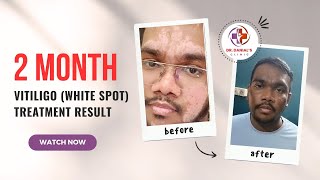 2 Months Before and After Patient Review  Vitiligo Transformation  Real Results Revealed [upl. by Poole491]