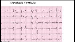 Extrasistole Ventricular EKG [upl. by Odraner]