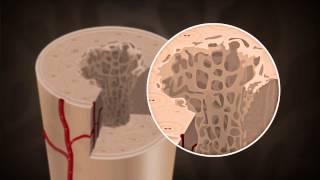 What causes Osteoporosis [upl. by Eejan713]