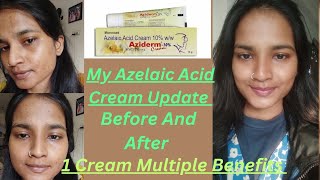 My Azelaic Acid Cream 10 Update  Before And After  Azidem Cream  1 Cream Multiple Benefits [upl. by Hahnke]