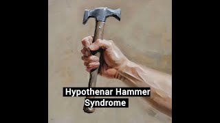 Hypothenar Hammer Syndrome [upl. by Hsakaa]