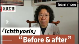 Ichthyosis treatment before and after ichthyosis ichthyosisvulgaris dryskin dermatologist [upl. by Akimrej794]