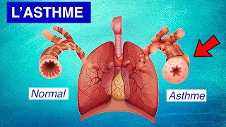 Asthme bronchique  Physiopathologie Symptômes et Traitements [upl. by Moselle38]