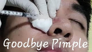 Fast Acne Treatment via Intralesional Corticosteroid Injection [upl. by Navaj496]