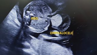 Omphalocele in ultrasound Usg [upl. by Maridel]