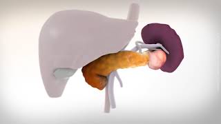 Laparoscopic distal pancreatectomy [upl. by Ellak]