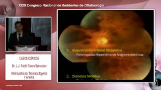 Retinopatía por Trombocitopenia  Dr J J Pablo Rivera  14022015 [upl. by Billy]