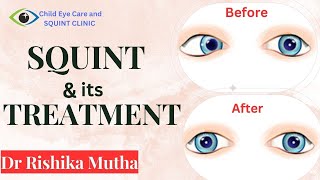 Squint specialist in indore  Squint and its treatment [upl. by Halac909]