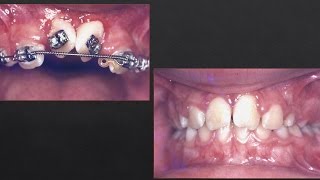 2 Incisors Rotated Orthodontics [upl. by Adranoel438]