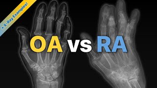 Osteoarthritis OA vs Rheumatoid Arthritis RA Explained  XRay Examples [upl. by Eyoj]