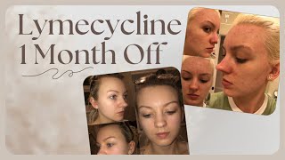 1 MONTH OFF LYMECYCLINE [upl. by Montagna958]