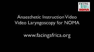 Anaesthesia Video Laryngoscopy in NOMA case with trismus [upl. by Sosanna]