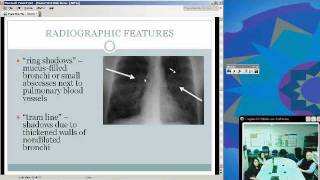 Allergic Bronchopulmonary Aspergillosis Sunena Argo MD [upl. by Hada]