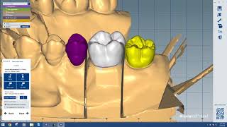 Designing with Amann Girrbach Ceramill Mind [upl. by Antonin626]