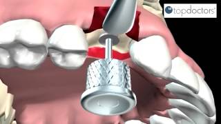 Implantes dentales qué son tratamiento y mantenimiento [upl. by Azitram143]