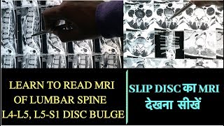 Learn to Read MRI of Slip DiscHow to read MRI of Lumbar Spine disc bulgeHerniated Disc MRI L4L5 [upl. by Araminta]