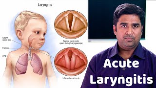 How do you Treat Laryngitis in 24 Hours  quotலாரின்ஜைடிஸ் quot சிகிச்சை  Dr Vignesh Gokul ENT Doctor [upl. by Jaehne39]