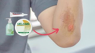 Healing Abrasions Effectively with Melaleuca Products [upl. by Ivah]