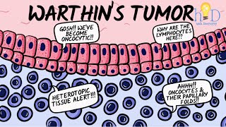 Warthins tumor [upl. by Nnylarak]