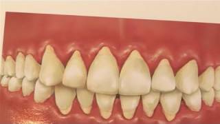 How To Treat Receding Gums [upl. by Senilec]