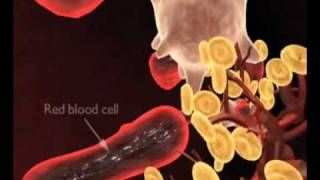 Periodontal disease and Systemic Health Issueswmv [upl. by Verge459]