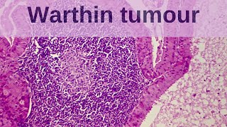 Warthin Tumour  Pathology mini tutorial [upl. by Nivloc856]