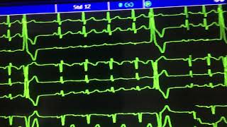 EXTRASISTOLES VENTRICULARES UNIFOCALES FRECUENTES EN TRAZO ELECTROCARDIOGRAFICO DE MONITOR ♥️ [upl. by Atalanta]