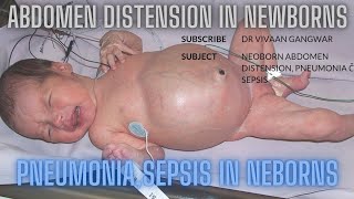 Abdominal Distension In Neonates  Pneumonia In Neonates  Sepsis In Newborn  Neonates In NICU [upl. by Kirstyn310]