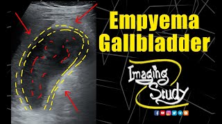 Empyema Gallbladder  Ultrasound  Case 322 [upl. by Ytisahc]