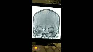 Cerebral Angiography Procedure [upl. by Eessac]