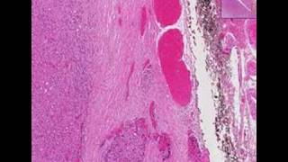 Histopathology ThyroidFollicular carcinoma [upl. by Ressler]